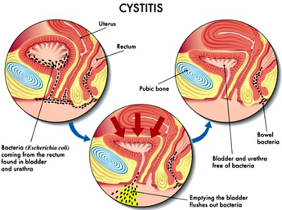 What causes a burning sensation in the lower abdomen?