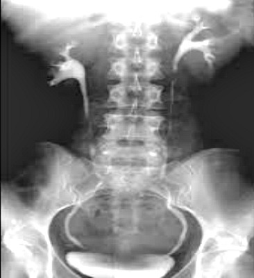 Picture of an intravenous urogram film.