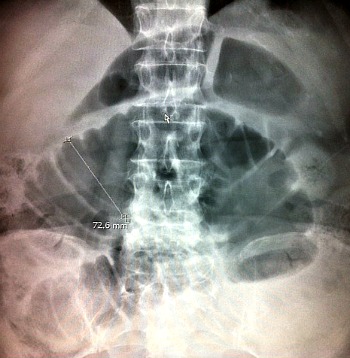 Symptoms of abdominal adhesion in this 50 year old lady lead to a diagnosis of bowel obstruction