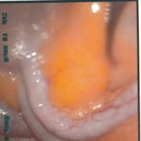 Picture Of The Appendix - What Are The Symptoms Of Appendicitis