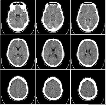 What Is CT Scan - Computed Tomography Scan