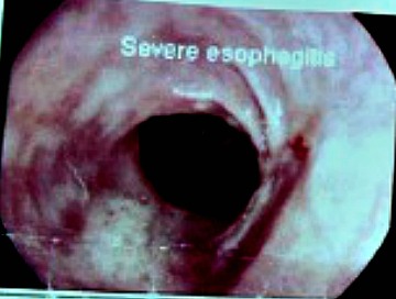 Esophagoscopy