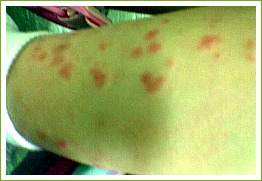 Henoch Schonlein Purpura or hsp is a common cause of rash and abdominal pain