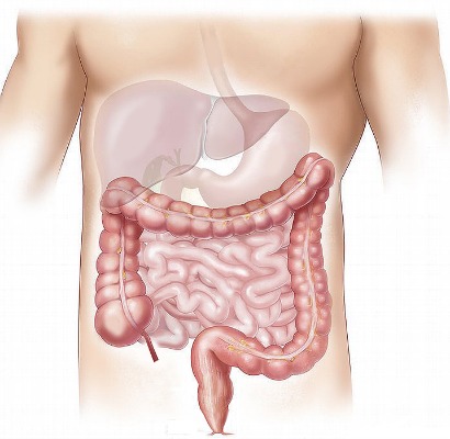 Irritable bowel syndrome or ibs is caused by abnormal contraction of the muscle in the large intestine due to irritation from disruption in the balance of normal gut sensitivity.