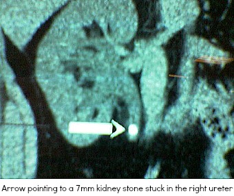 Right kidney stone