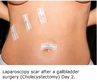 Laparoscopy scars after a gallbladder was removed through keyhole surgery