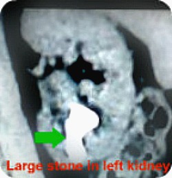 Large stone in lower pole of left kidney, causing continuous left sided abdominal pain for years.