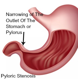 Pyloric stenosis - a cause of abdominal pain in babies 0 to 3 months old.