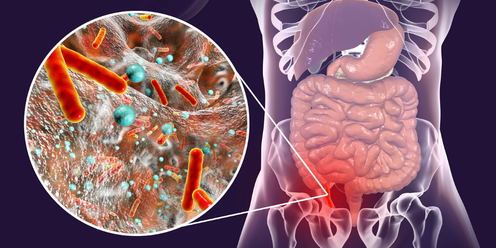 the inflamed acute appendix and causes