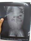 X-ray on 2nd mrch