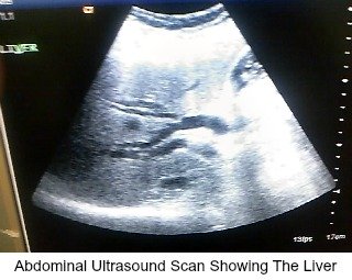 Abdominal Ultrasound Scan Showing The Liver
