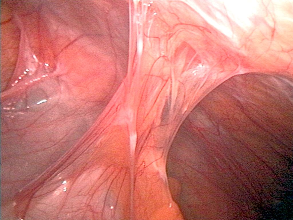 Abdominal Adhesion