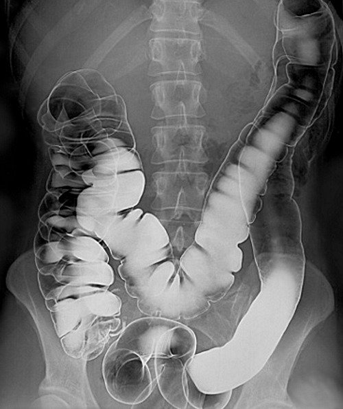 Picture of barium enema film.