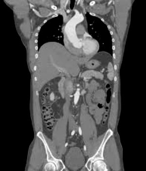 CT scan showing organs and structures in the abdomen.