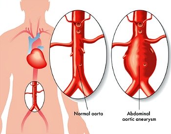 Abdominal Aneurysm is a localized ballooning of a segment of the aorta. It could be fatal.