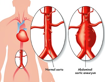 Abdominal aortic aneurysm diagram