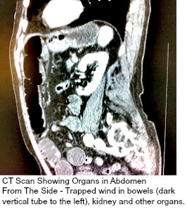 Ct Scan For Central Abdominal Pain