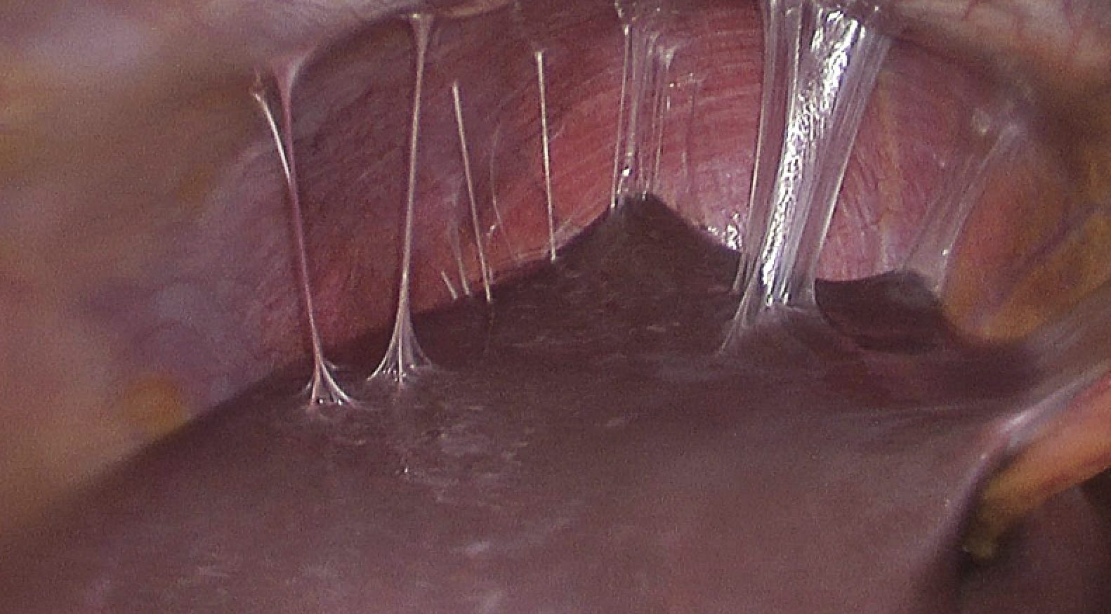Abdominal Adhesion