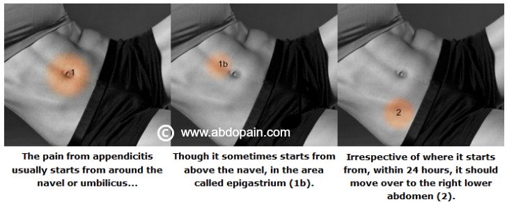 Acute Appendicitis is one of the most important causes of pain around the belly button or umbilicus.