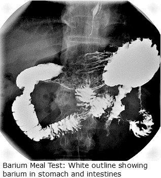 Barium meal - A film showing a barium meal x-ray examination