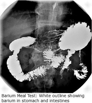 Barium meal - A film showing a barium meal x-ray examination