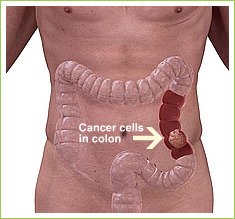 Causes of abdominal pain are many. Bowel cancer could be one especially in the elderly. See what the symptoms are. Follow the link below.