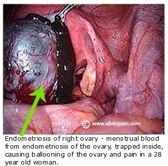 Endometriosis of right ovary in a 28 year old woman.