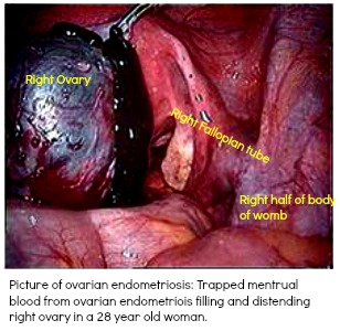 Endometriosis involving an ovarian cyst