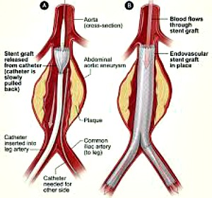 Endovascular Abdominal Aortic Aneurysm Repair