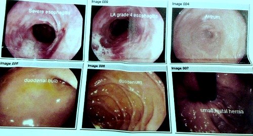 Oesophagogastroduodenoscopy pictures