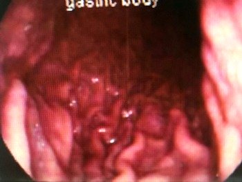 A Healthy Gastric Mucosa - What The Inside Of A Normal Stomach Looks Like.