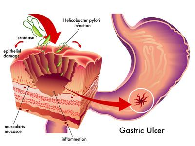 Gastric Ulcer - What The Inside of A Stomach With An Ulcer Looks Like.