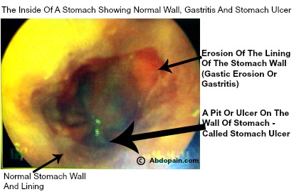 Indigestion is most commonly caused by troubles with the stomach wall, duodenum and lower oesophagus.