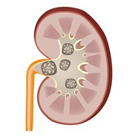 Kidney Stones