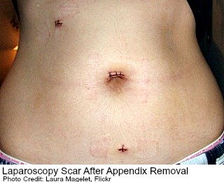 Laparoscopy scars after removal of the appendix
