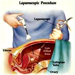 Laparoscopy picture showing: What is laparoscopy?