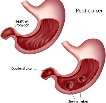 Irritation of the stomach wall leads to stomach ulcer and abdominal pain piercing through to the back