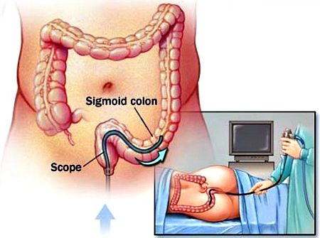 Sigmoidoscopy procedure in progress.