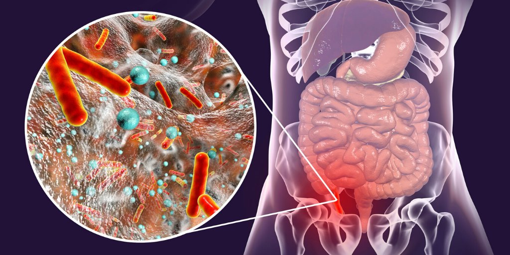 Causes of appendicitis include any condition that leads to obstruction of the lumen of the appendix causing bacterial overgrowth.