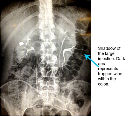 Trapped intestinal gas as seen on an x-ray of the abdomen of a 39 year old lady.