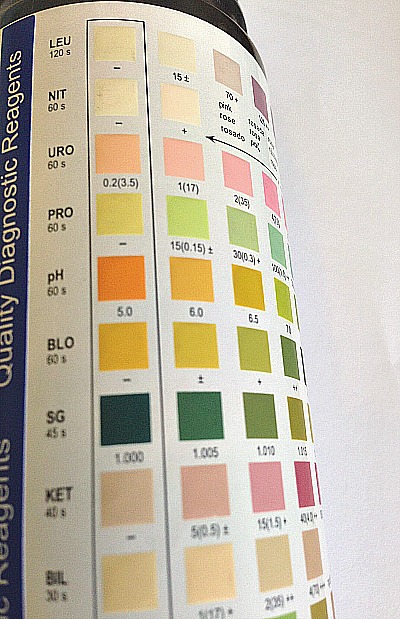 Urinalysis is one of the most commonly done urine test in the world.