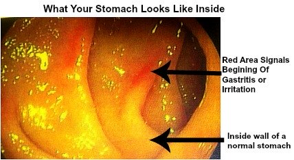 Alcoholic Gastritis: Note the two red spots due to irritation of the wall of the stomach in this patient.